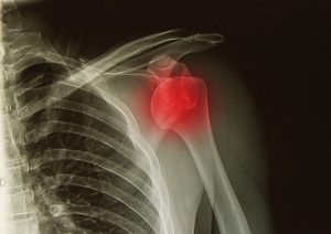 These reasons are why you are having serious shoulder pain.