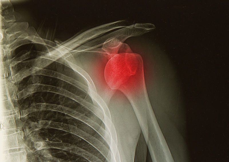 3 Shoulder Exercises to Avoid if you are having shoulder pain.